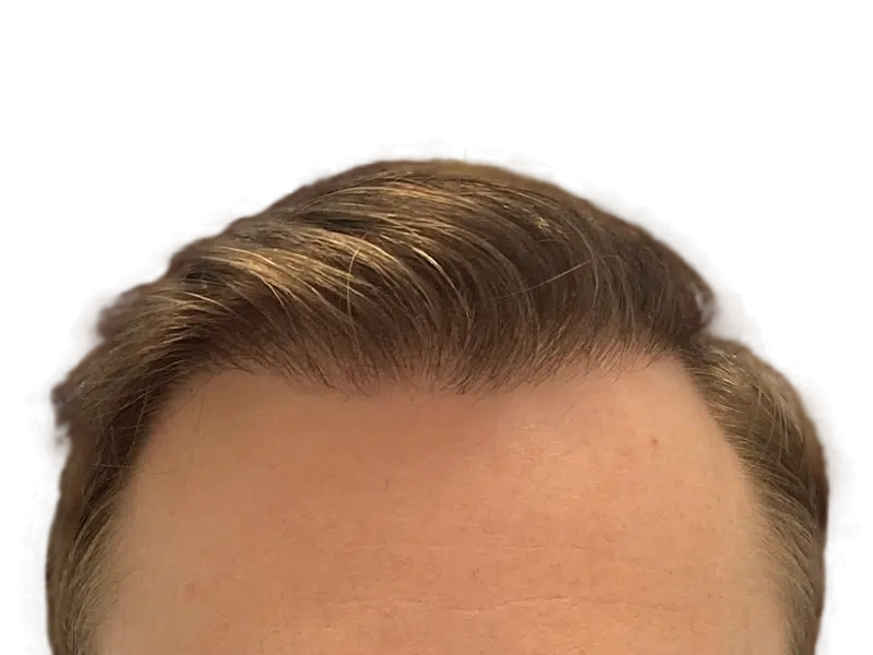 Dense, light brown hairline. Possible hair transplant result. Forehead view. Hair restoration success.