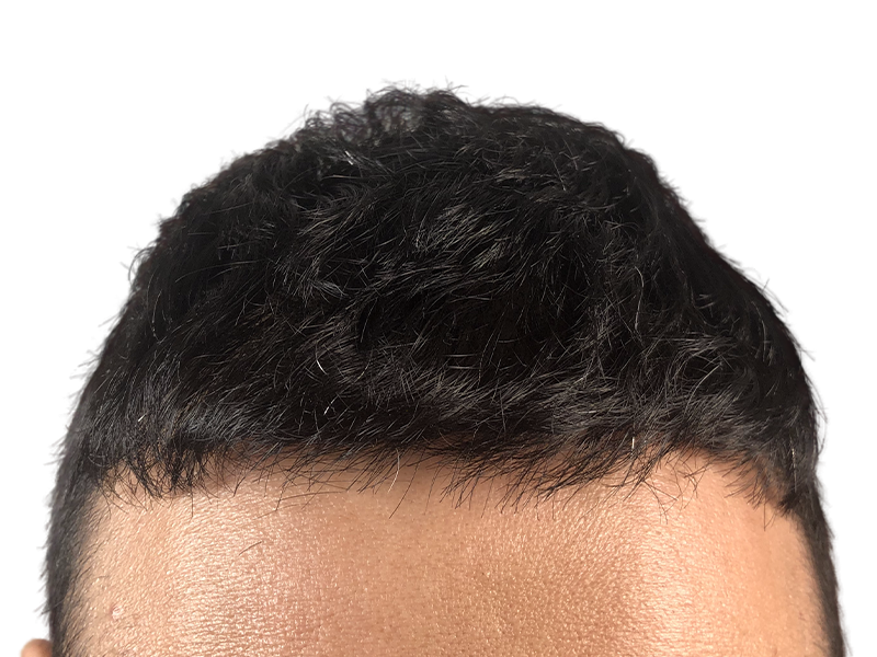 Hair transplant result: Dense, natural hairline restoration. Before/after example of successful hair loss treatment.