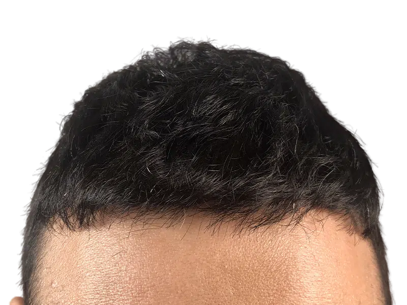 Hair transplant result: Dense, natural hairline restoration. Before/after example of successful hair loss treatment.