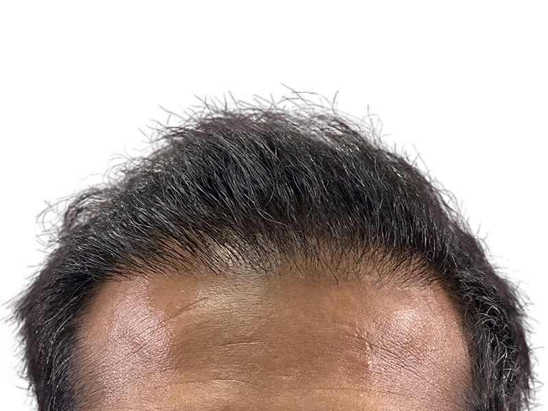 Thinning hairline before hair transplant. Graying hair, receding hairline. Hair restoration candidate. Before photo.