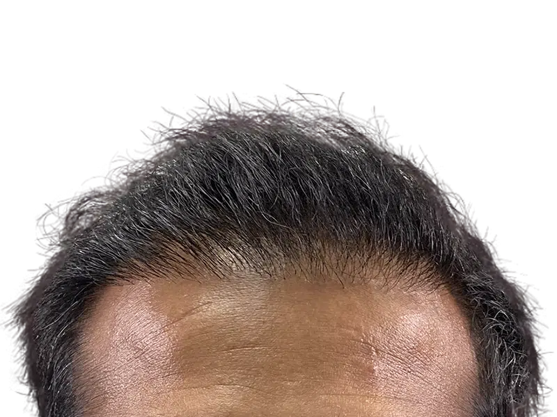 Thinning hairline before hair transplant. Graying hair, receding hairline. Hair restoration candidate. Before photo.