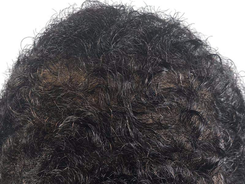 Thinning dark, curly hair. Possible hair loss before hair transplant. Hair restoration candidate.
