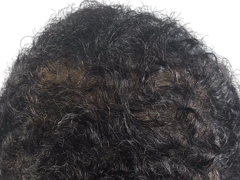 Thinning dark, curly hair. Possible hair loss before hair transplant. Hair restoration candidate.
