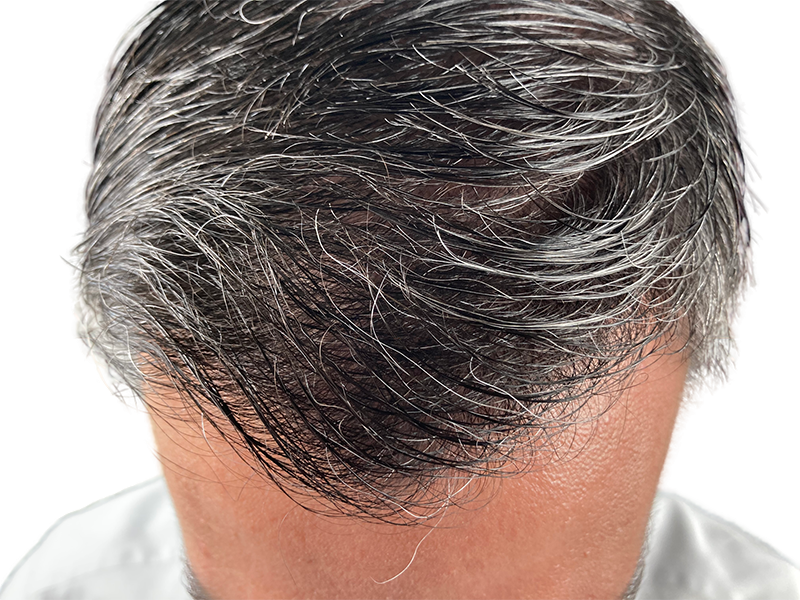 Thinning gray & dark hair. Potential hair restoration candidate. Before treatment example. Visible scalp.