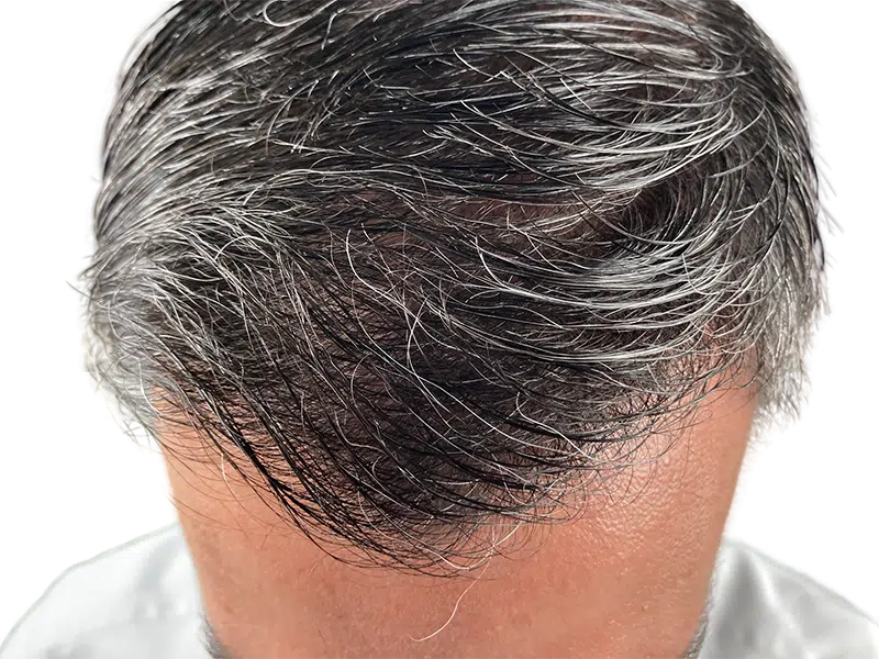 Thinning gray & dark hair. Potential hair restoration candidate. Before treatment example. Visible scalp.