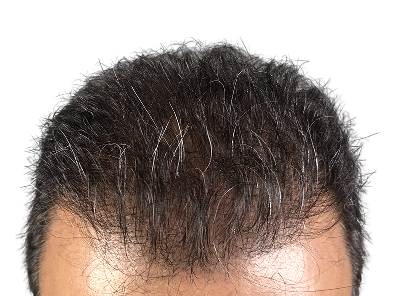 Hair transplant result: Dark hair with graying, styled forward. Density and distribution visible. Hair restoration example.