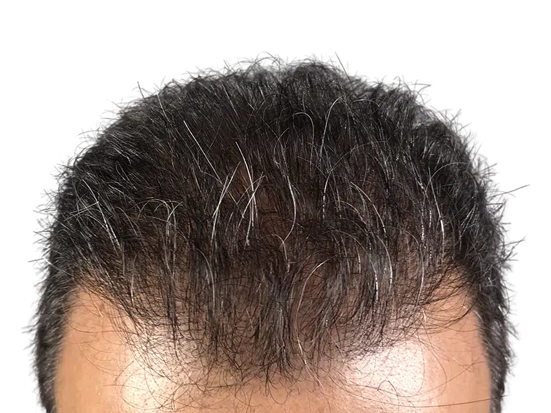 Hair transplant result: Dark hair with graying, styled forward. Density and distribution visible. Hair restoration example.