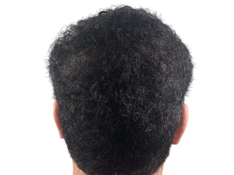Thinning crown hair. Potential hair transplant candidate. Before/after comparison needed for results. Hair restoration option.