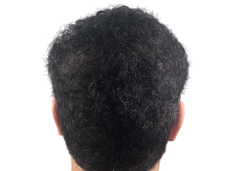 Thinning crown hair. Potential hair transplant candidate. Before/after comparison needed for results. Hair restoration option.