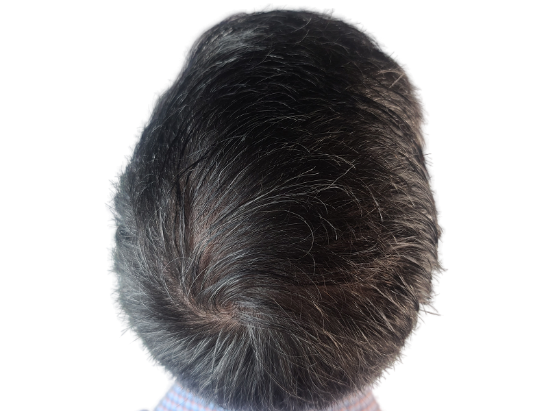 Thinning hair at crown. Hair restoration candidate? Potential hair transplant before/after result. Dark hair with gray.