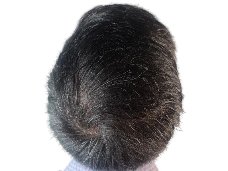 Thinning hair at crown. Hair restoration candidate? Potential hair transplant before/after result. Dark hair with gray.