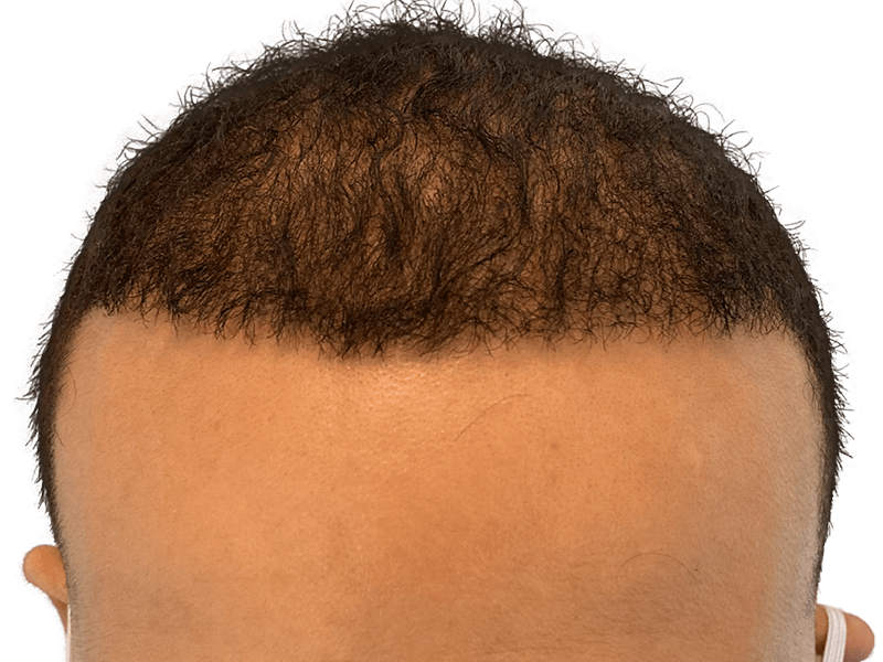 Receding hairline before hair transplant. African American/Hispanic man. Hair restoration candidate. Sparse frontal hair density.