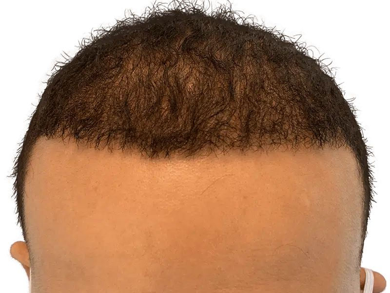 Receding hairline before hair transplant. African American/Hispanic man. Hair restoration candidate. Sparse frontal hair density.