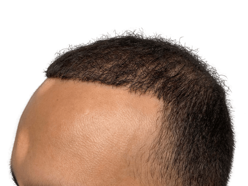 Hair transplant result: Natural hairline restoration on dark skin. Density and texture visible. Hair restoration success.