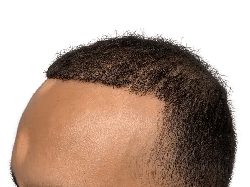 Hair transplant result: Natural hairline restoration on dark skin. Density and texture visible. Hair restoration success.
