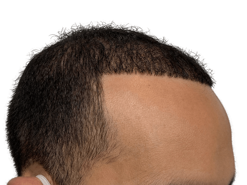 Hair restoration result: Dense, even hairline achieved with hair transplant. Before & after transformation.