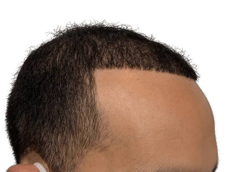 Hair restoration result: Dense, even hairline achieved with hair transplant. Before & after transformation.