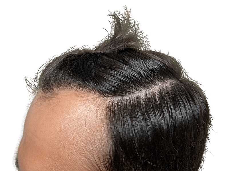 Hair transplant result: Dark hair, improved hairline. Before & after hair restoration example.