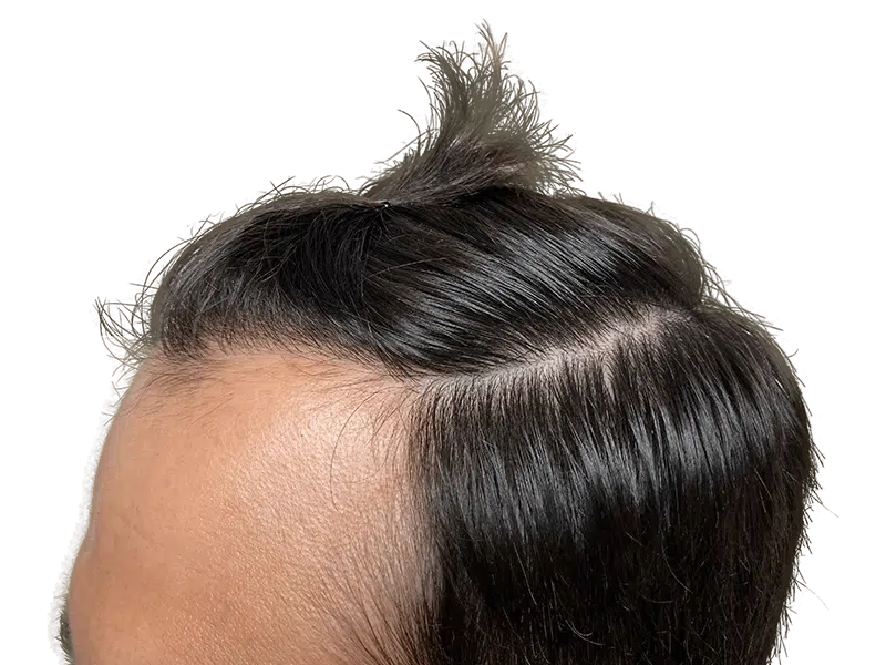 Hair transplant result: Dark hair, improved hairline. Before & after hair restoration example.