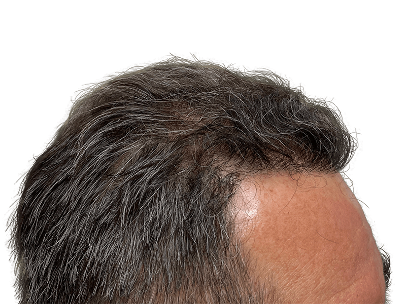 Before & After Hair Transplant: Graying hair restoration results. See improved density and coverage.