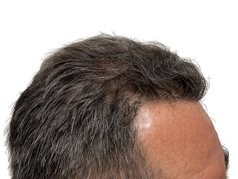 Before & After Hair Transplant: Graying hair restoration results. See improved density and coverage.