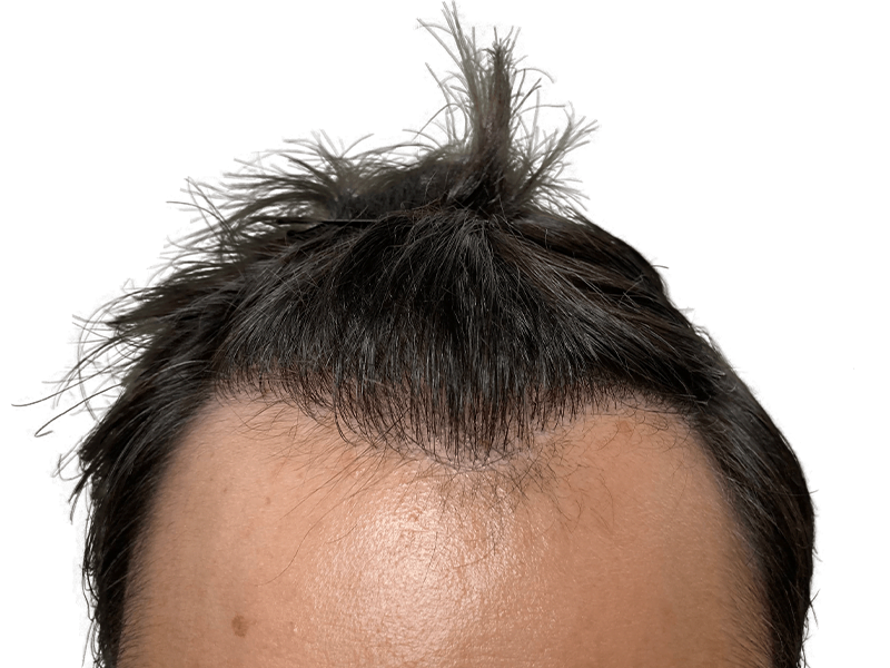 Hair transplant result: Dark hair, improved density. Caucasian man's forehead showing restored hairline. Hair restoration success.