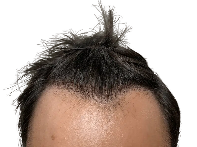 Hair transplant result: Dark hair, improved density. Caucasian man's forehead showing restored hairline. Hair restoration success.