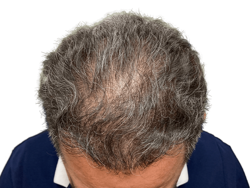 Thinning gray hair at crown. Scalp visible. Consider hair restoration options. Before hair transplant assessment.