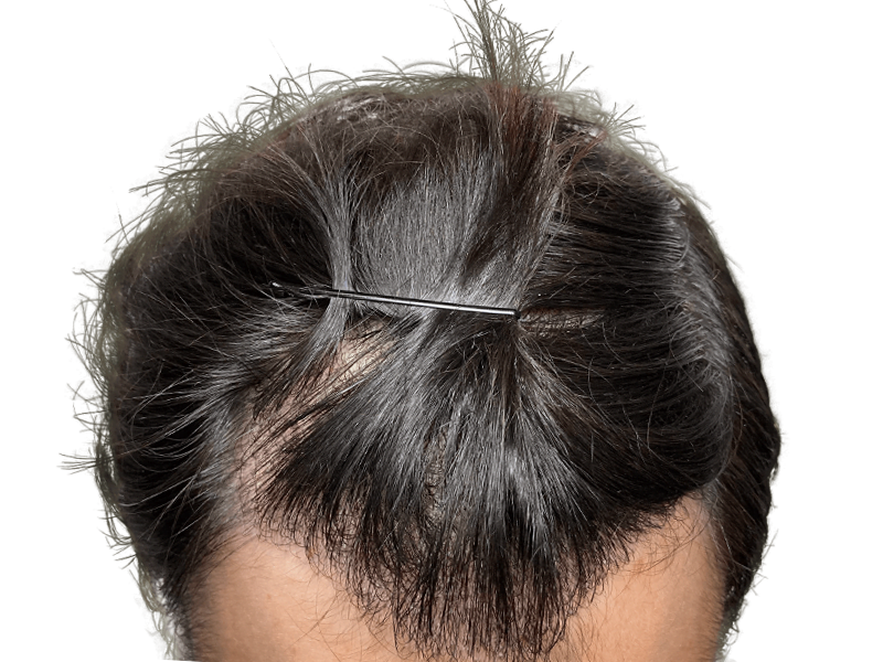 Thinning dark hair at the hairline. Potential hair loss before hair restoration or transplant. Hair clip visible.
