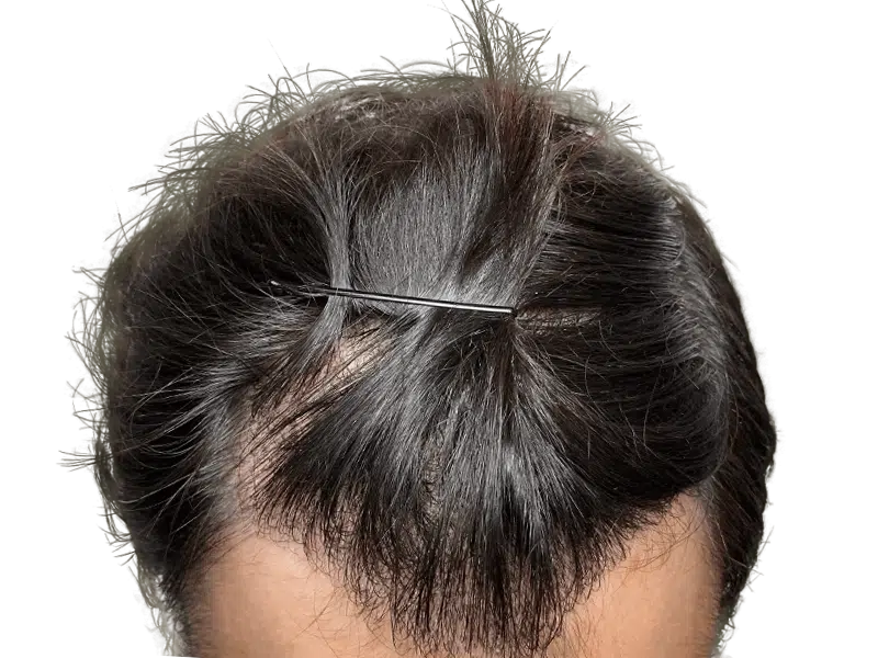 Thinning dark hair at the hairline. Potential hair loss before hair restoration or transplant. Hair clip visible.