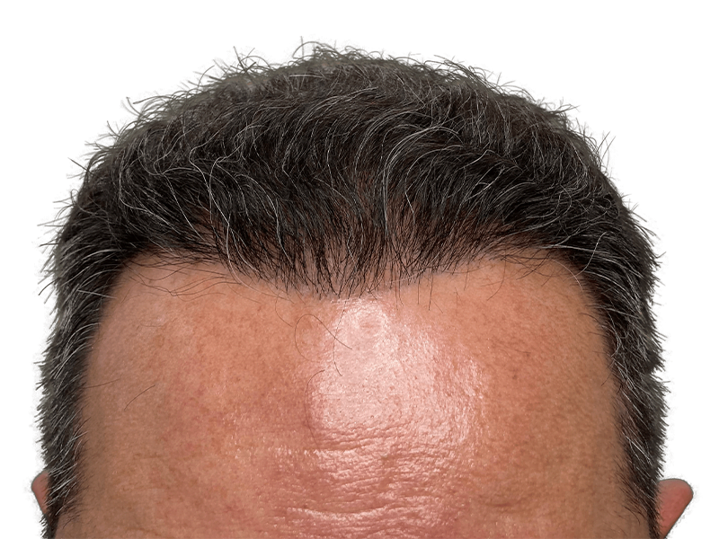 Hair transplant result: Restored hairline on middle-aged man. Before & after hair restoration procedure. Dense, natural-looking hair.