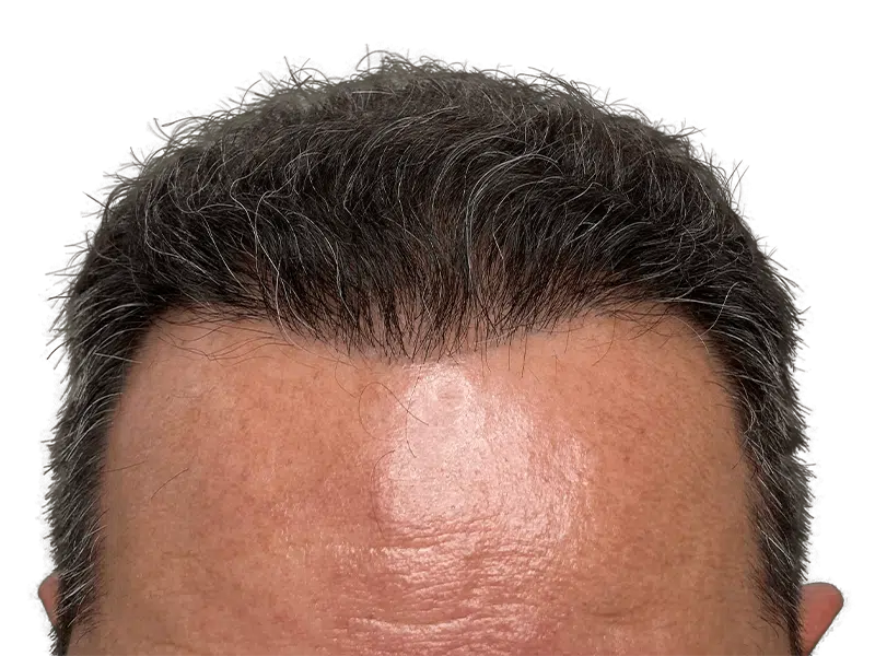 Hair transplant result: Restored hairline on middle-aged man. Before & after hair restoration procedure. Dense, natural-looking hair.