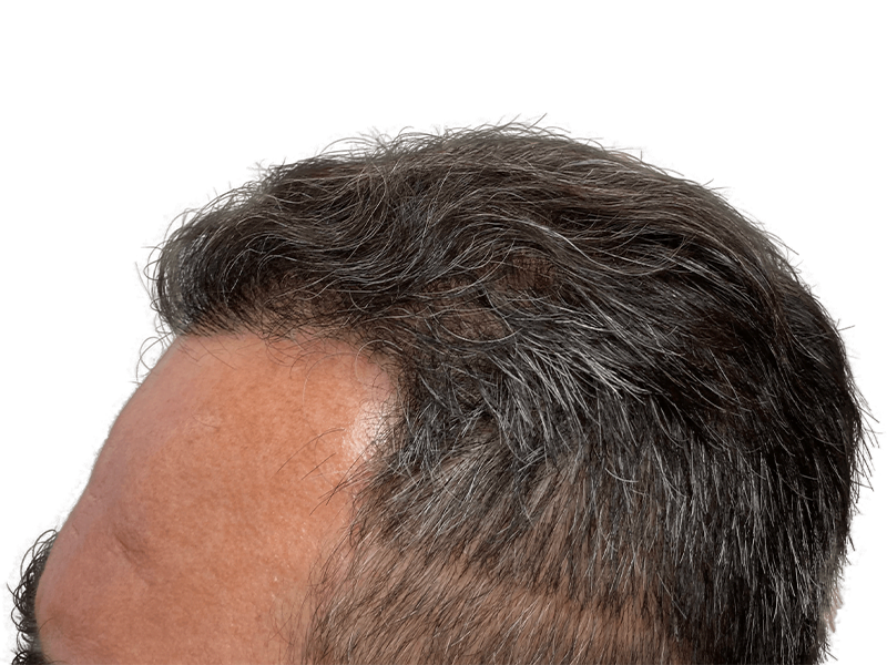 Hair transplant close-up. Graying hair, showing hairline and density. Potential before/after comparison for hair restoration results.