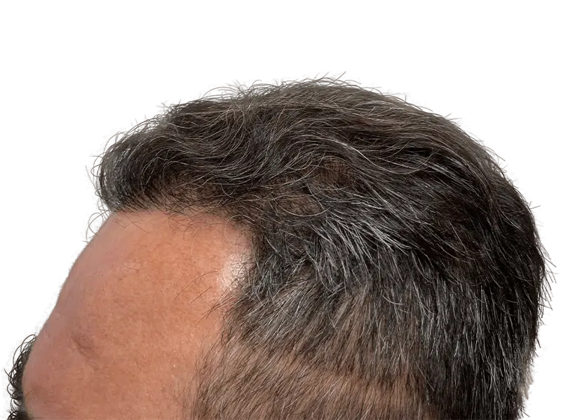 Hair transplant close-up. Graying hair, showing hairline and density. Potential before/after comparison for hair restoration results.