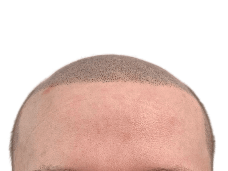 Hair transplant before & after: Restored hairline with new hair growth. Forehead redness visible post-procedure.