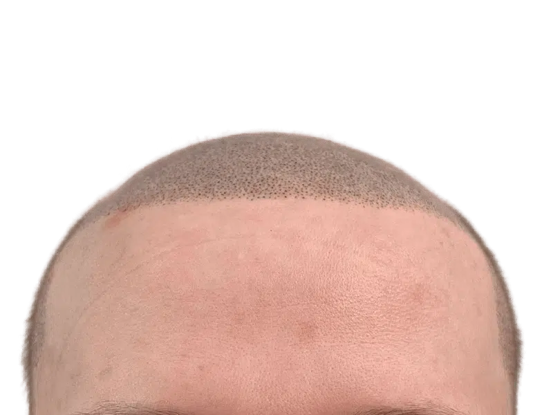 Hair transplant before & after: Restored hairline with new hair growth. Forehead redness visible post-procedure.
