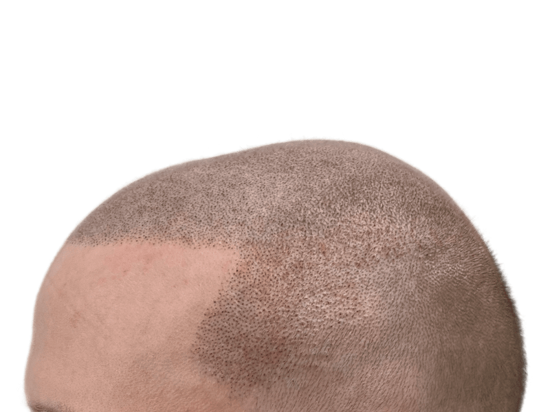 Scalp micropigmentation (SMP) close-up. Before & after hair restoration results on Caucasian male. Mimics shaved head look.