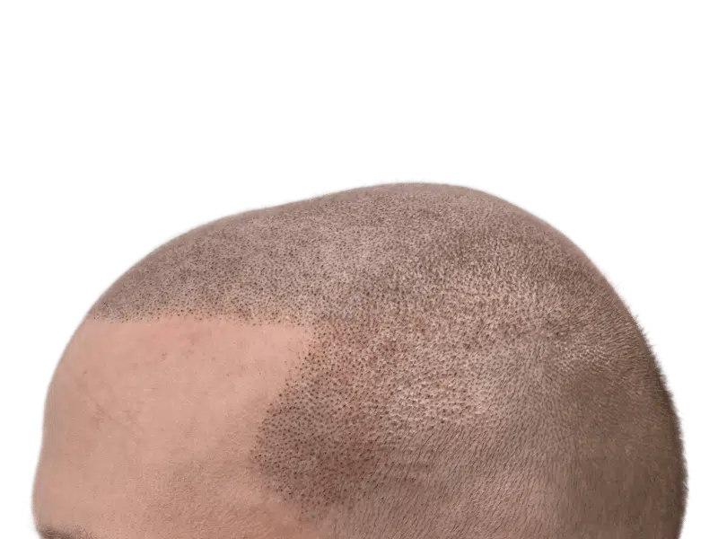 Scalp micropigmentation (SMP) close-up. Before & after hair restoration results on Caucasian male. Mimics shaved head look.