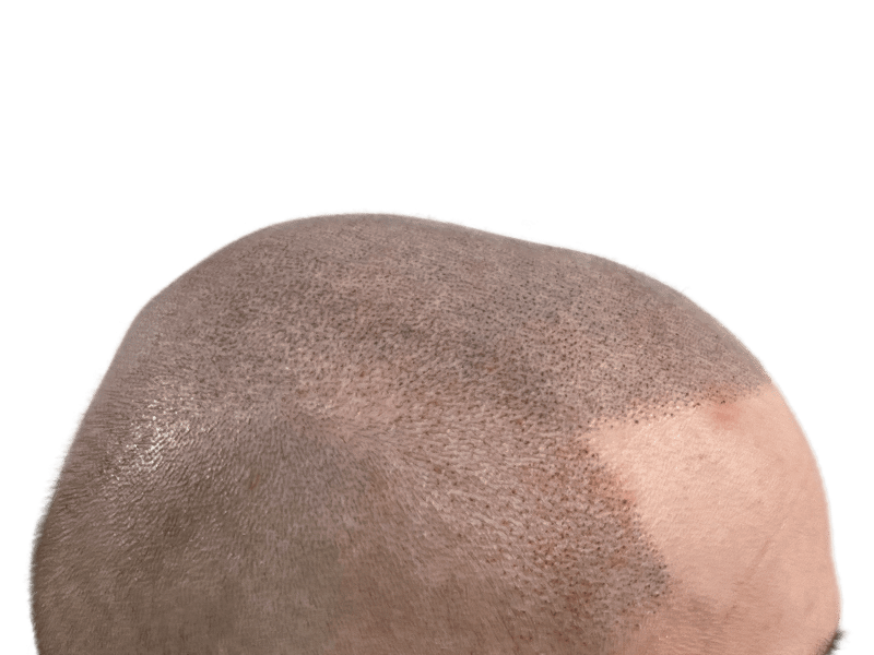 Hair transplant result: denser hair on top, improved coverage. Before/after comparison. Hair restoration success.