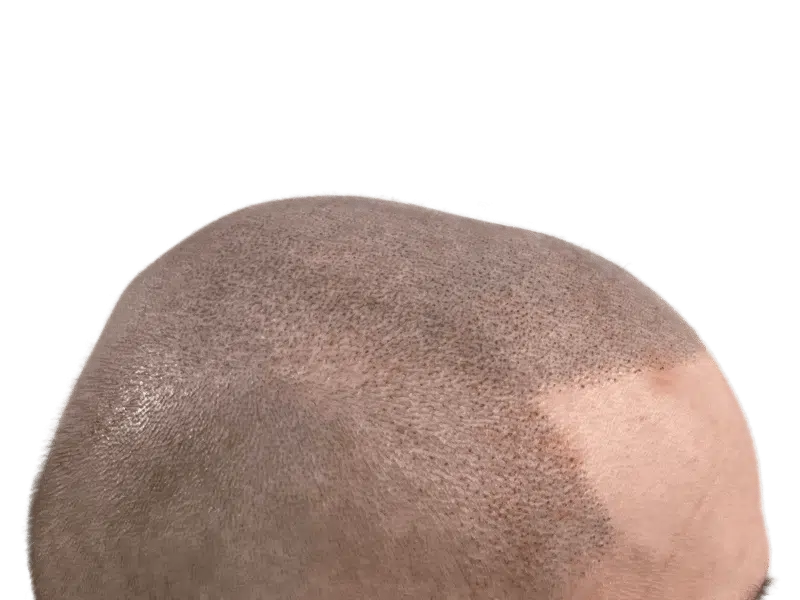 Hair transplant result: denser hair on top, improved coverage. Before/after comparison. Hair restoration success.
