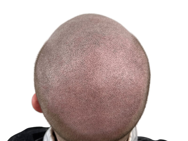 Hair transplant result: Full head of hair achieved. Close-up of scalp showing even follicle density after hair restoration procedure.
