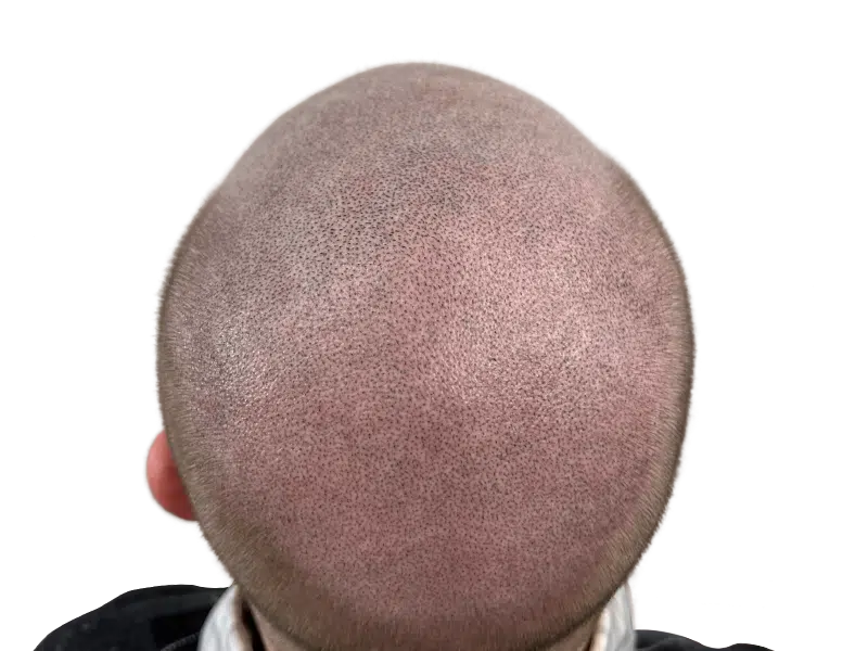 Hair transplant result: Full head of hair achieved. Close-up of scalp showing even follicle density after hair restoration procedure.