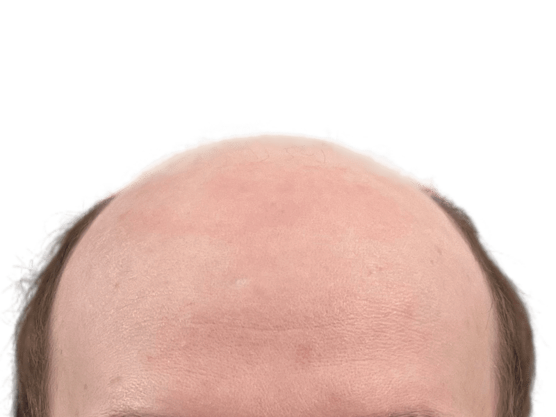 Receding hairline. Potential hair transplant candidate. Sparse hair suggests possible hair restoration. No before/after shown.