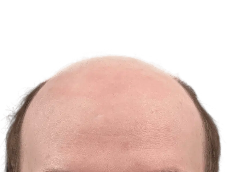 Receding hairline. Potential hair transplant candidate. Sparse hair suggests possible hair restoration. No before/after shown.