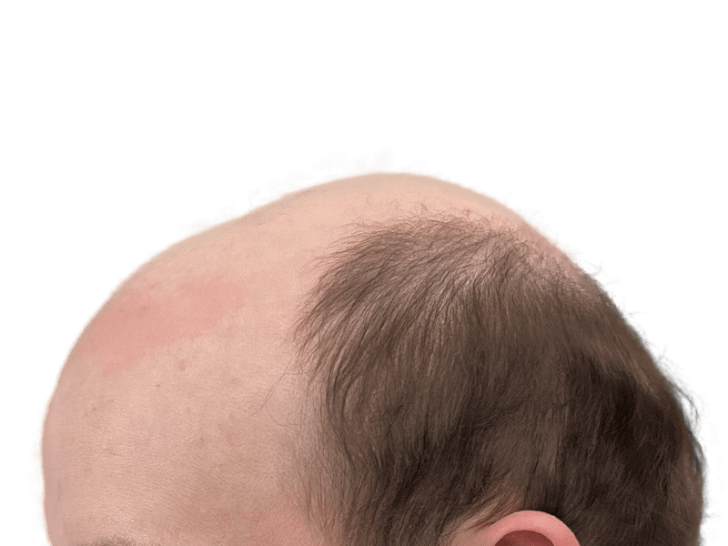 Balding head with thinning brown hair. Hair loss example for hair restoration or transplant consideration.