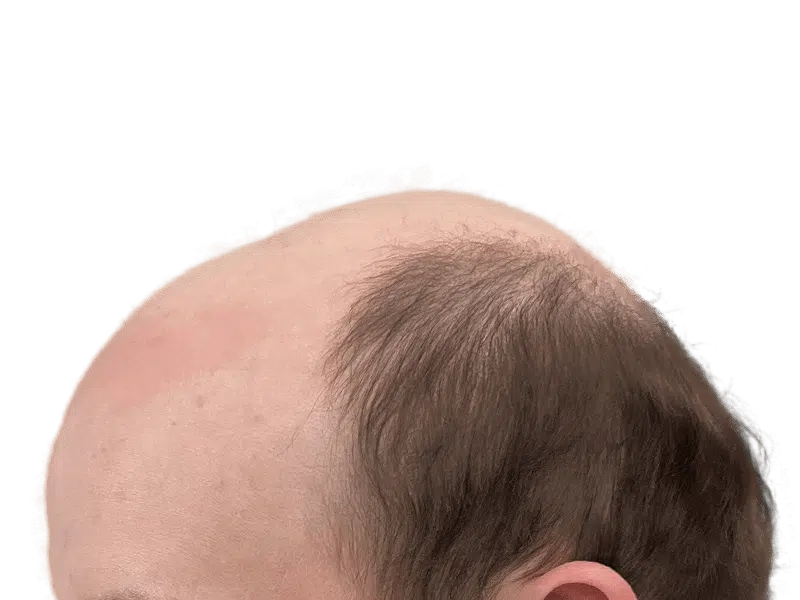 Balding head with thinning brown hair. Hair loss example for hair restoration or transplant consideration.