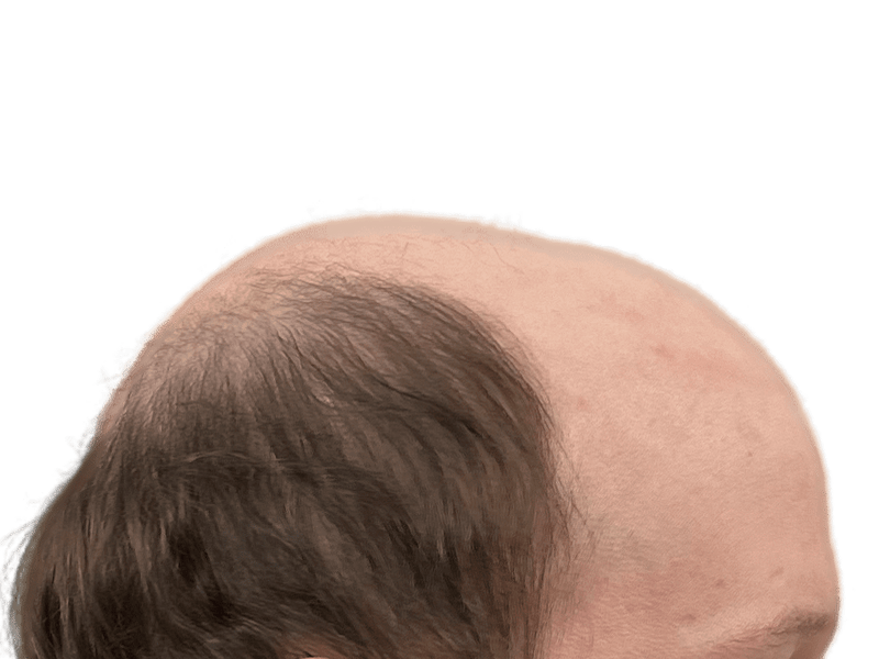 Balding head with thinning brown hair. Potential candidate for hair restoration or hair transplant procedure.