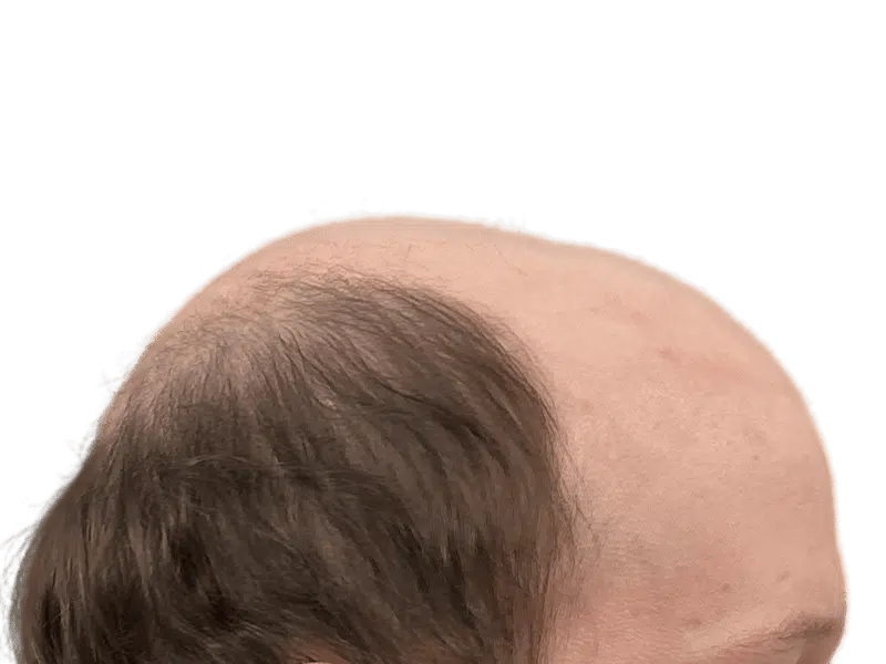 Balding head with thinning brown hair. Potential candidate for hair restoration or hair transplant procedure.
