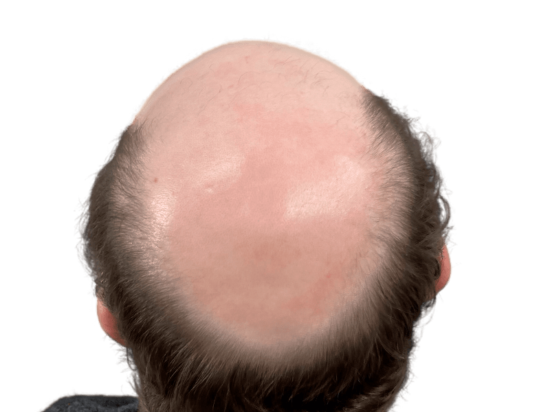 Balding man's head: potential hair transplant candidate. Shows hair loss pattern before restoration. Fair skin tone.