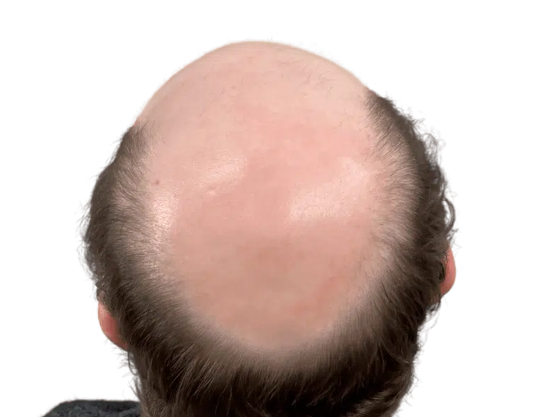 Balding man's head: potential hair transplant candidate. Shows hair loss pattern before restoration. Fair skin tone.